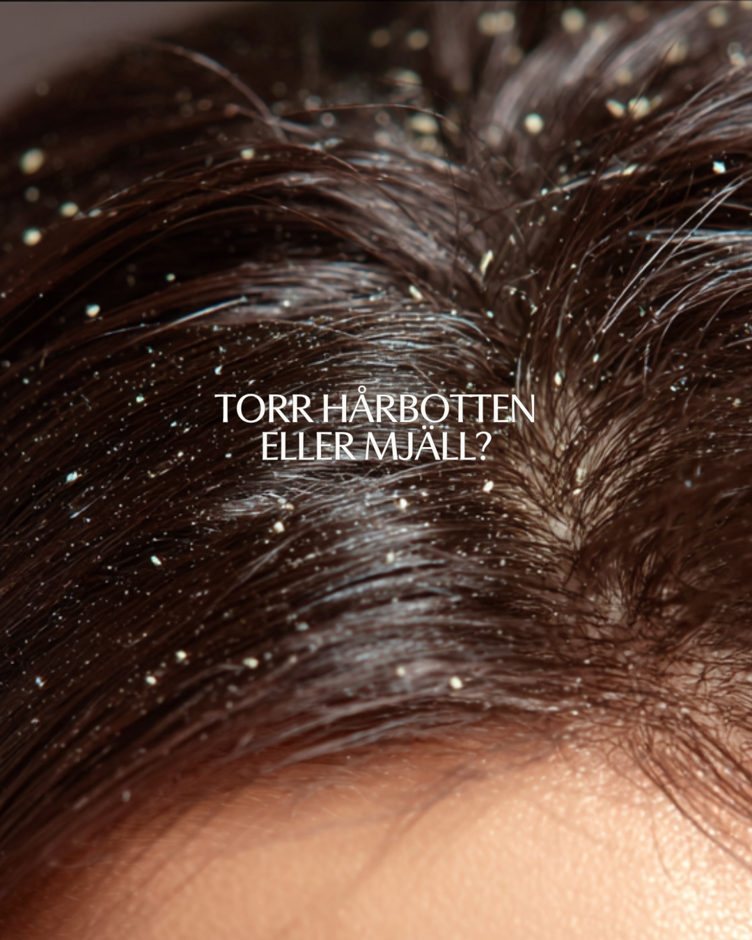 Närbild på mörkt hår med synliga mjällflagor i hårbotten. Bilden illustrerar skillnaden mellan torr hårbotten och mjäll.